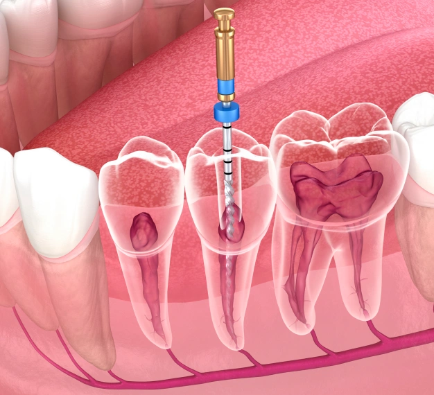 Illustration of an endodontic root canal procedure showing the tooth structure and treatment process in Scottsdale