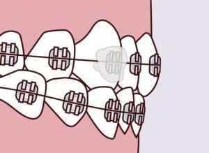 Illustration of braces with a loose band or bracket representing orthodontic emergency care instructions at Dentistry of Old Town Scottsdale