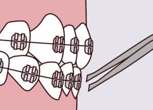 Illustration of braces with a loose wire representing orthodontic emergency instructions for a loose wire in Scottsdale