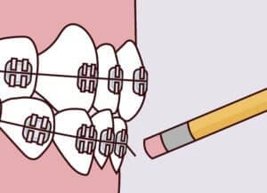 Illustration of braces with a poking wire representing orthodontic emergency care instructions for a poking wire in Scottsdale