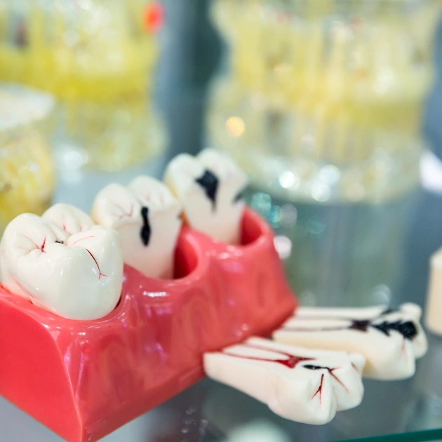 Dental model showing a guided tissue regeneration procedure representing periodontal regeneration services in Scottsdale