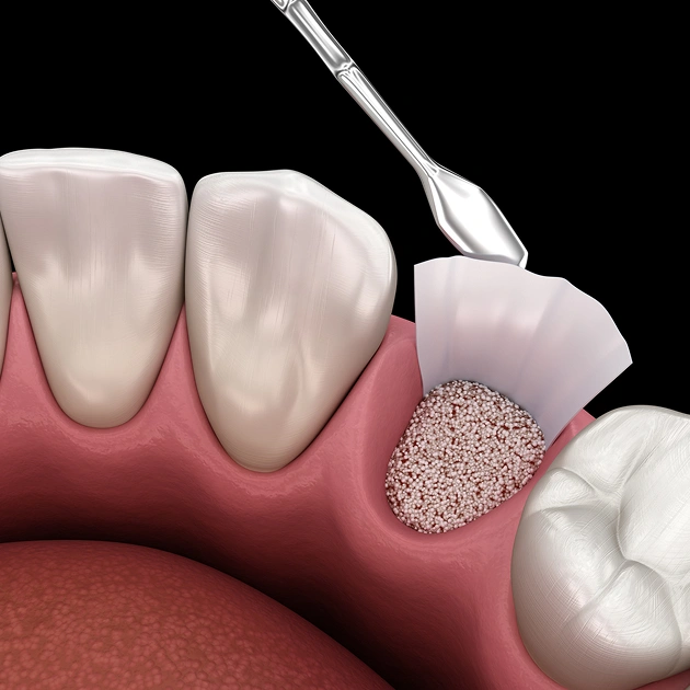 Illustration of a gum grafting procedure on a tooth model representing gum graft services at Dentistry of Old Town Scottsdale