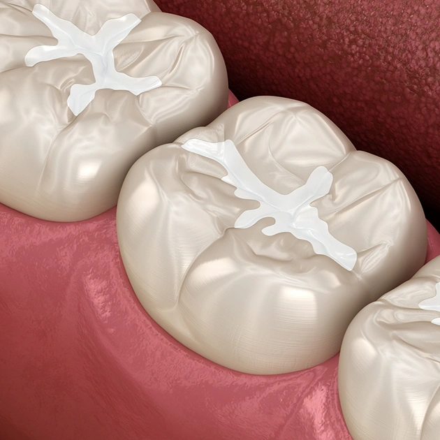 Close up of dental sealant material representing pit and fissure sealant services at Dentistry of Old Town Scottsdale