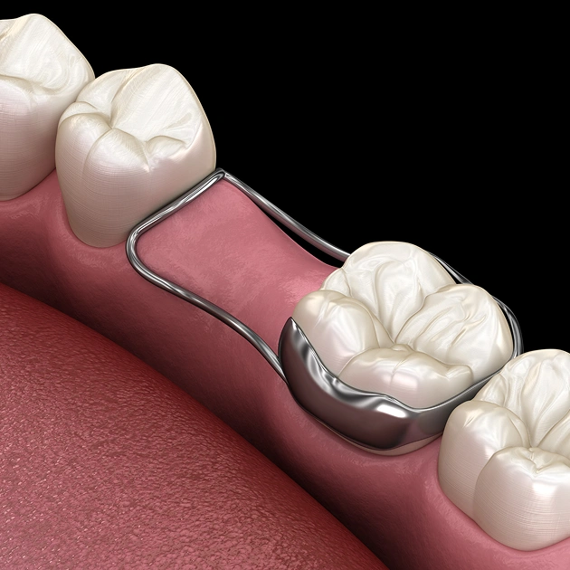 Dental model showing a space maintainer on teeth on a dark background representing space maintainer services for children in Scottsdale