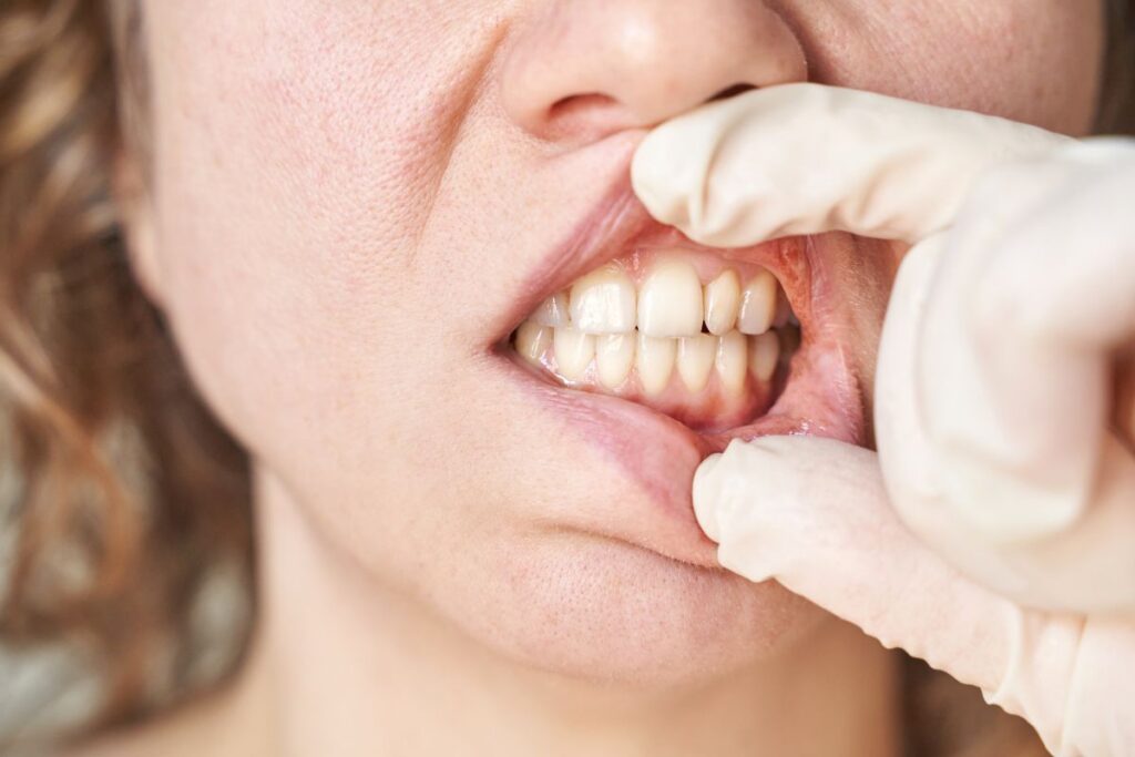 Dentist examining swollen gums that may be causing Sudden Tooth Pain